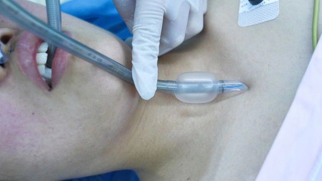 用管|插管深浅，一摸便知—触摸套囊法用于判断插管深度