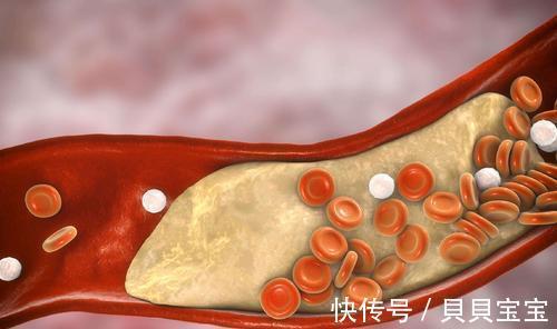身体|提醒：身体出现6个变化，暗示血脂已经升高，很多人容易忽视