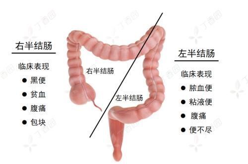 右半结肠癌|左半结肠癌 vs.右半结肠癌,这 4 大差异,你能答全吗?