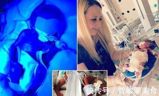 外科医生|英国妇女在怀孕21周时生下一个孩子宝宝是透明的，可以看到体内的血液流动