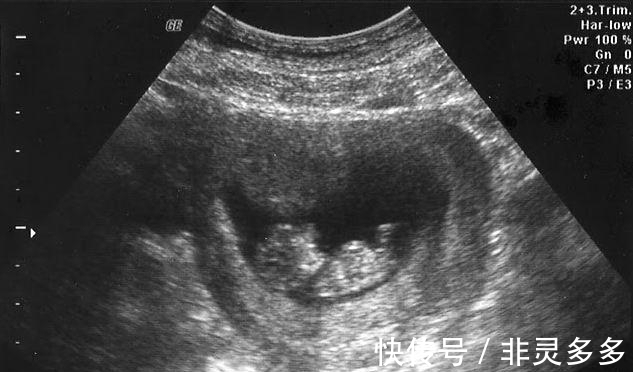 小孩|2岁女娃说我在肚子里玩一条线,,医生:再慢1天小孩就没了