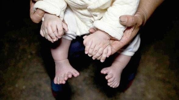 宝妈|婴儿出生时有30多个手指医生看到了宝妈的手,明白了原因
