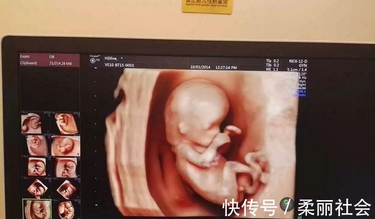 四维彩超|四维彩超单上4个数据,暗示了胎儿秘密,你知道了吗?