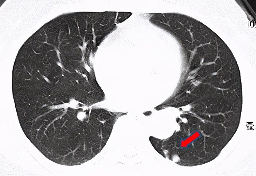  结节|刀下“留肺”！容易误认为癌性“肺结节”的8种感染