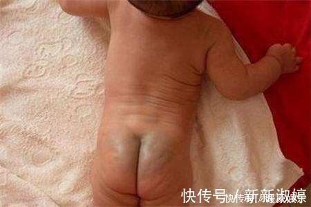 蒙古斑|为什么宝宝的屁屁都有青痕,其实屁屁上有青痕的宝宝都是有故事的