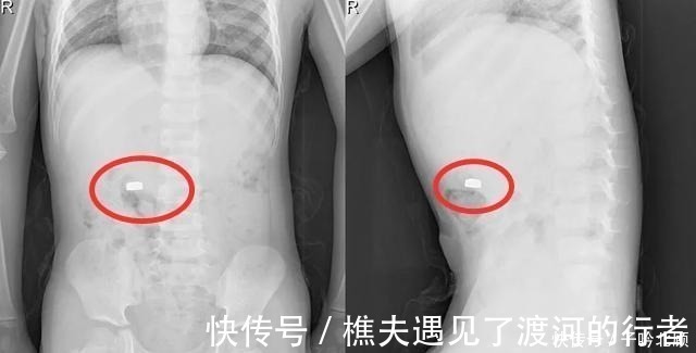 宝妈|“妈妈,我有个秘密”听完5岁儿子说的话,宝妈抱着孩子冲进医院!