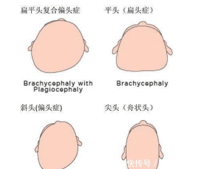 定型枕|宝宝头睡偏了要如何矫正建议收藏！修正育儿系列！