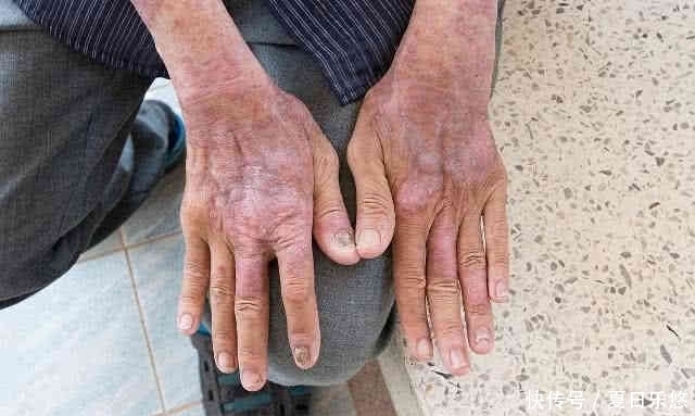 体内血糖|血糖高不高,看看手,若没有3种情况,那就恭喜,血糖还不错