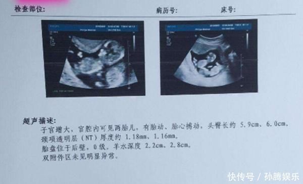 孕期5大“排畸”检查，其中3项每个孕妈都要做，快看你落下了哪个