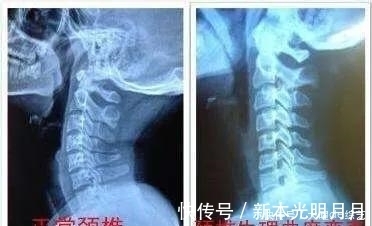 颈椎|预防颈椎病,睡眠姿势很关键,听听医怎么说