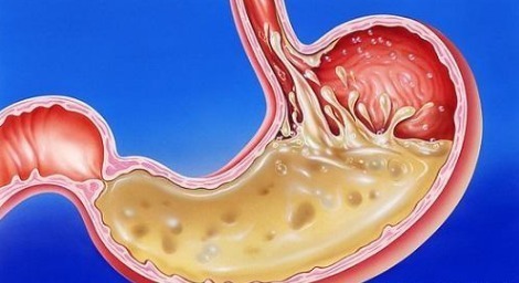 健康|浅表性胃炎经常不舒服,医生说不用吃药,养胃做好5点很关键