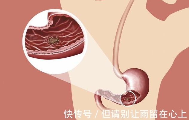 胃部|胃癌早期不痒不疼,饭后若有4个“异常”,可能需要就医了