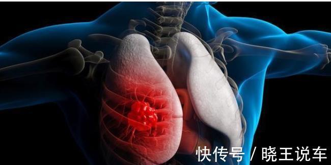 靶向|晚期肺癌,不治疗的患者能活多久?治疗后又能获得哪些好处?