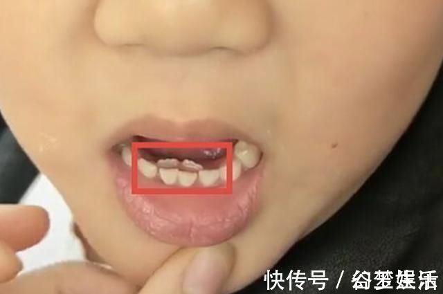 奶奶|7岁男孩长了“双排牙”,需要一颗一颗拔掉,奶奶自责不已