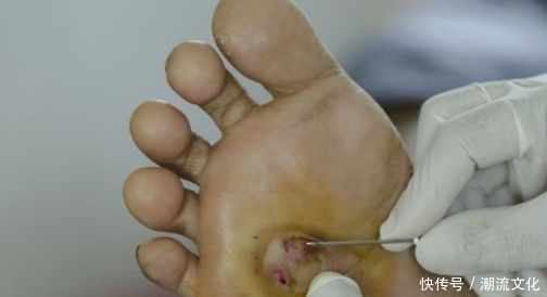 血液|天然“化栓王”被发现,早晚来点,赶跑血管垃圾,血栓慢慢消失