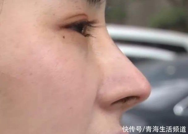 手术 妙龄女子花38000元隆鼻，术后却像“老鹰鼻”女子不敢回家了