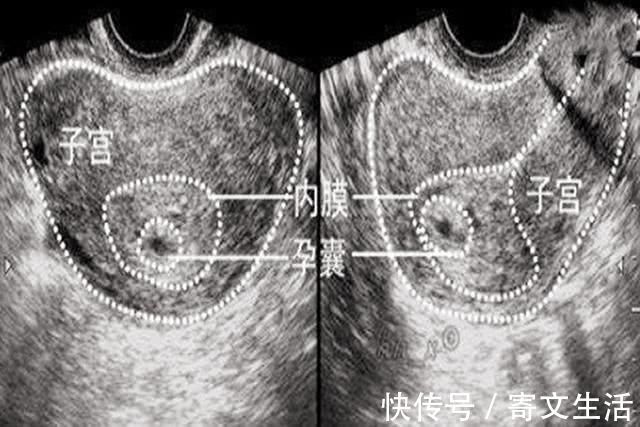 宫外孕|孕期第一次产检中，这三个指标合格，恭喜你，说明胎儿发育健康