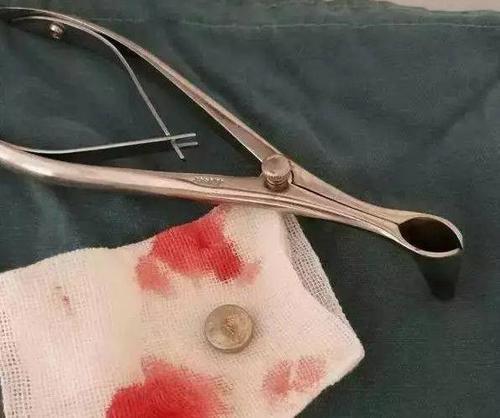 体温计|娃误食纽扣电池,妈妈“大题小做”的处理保住孩肠道,医生都称赞