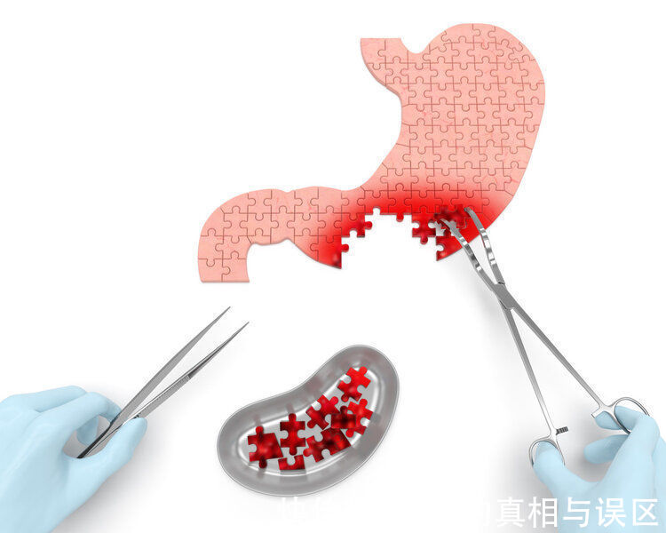 刘大爷|切除了良性胃息肉，两年后却癌变，大爷的这个错误，引以为戒