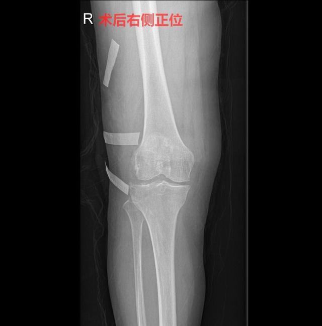 老太太|60岁老太太右膝痛了20年,一直治标不治本,结果查出这些问题