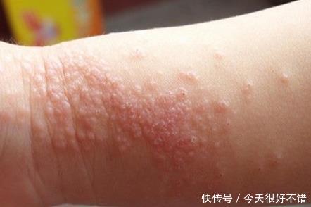 90中医首次公开 3防2用 湿疹治疗方法 告别激素药膏 皮肤换新 快资讯