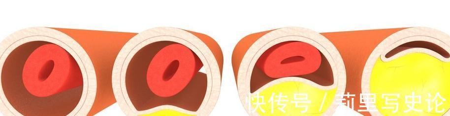 疫苗|“血脂疫苗”正式启用了,每年只需注射两次,什么人都可以打?