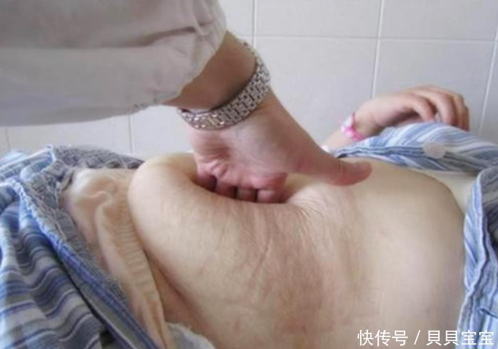 顺产|同样是剖腹产，为何有的产妇术后要“压肚子”，有的人则不用？