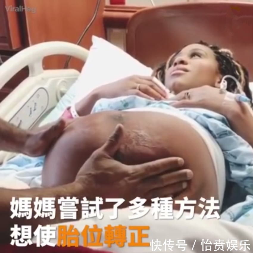 枕前位|医生徒手帮孕妈转胎位，当妈真的不容易，网友这肚皮都薄成纸了