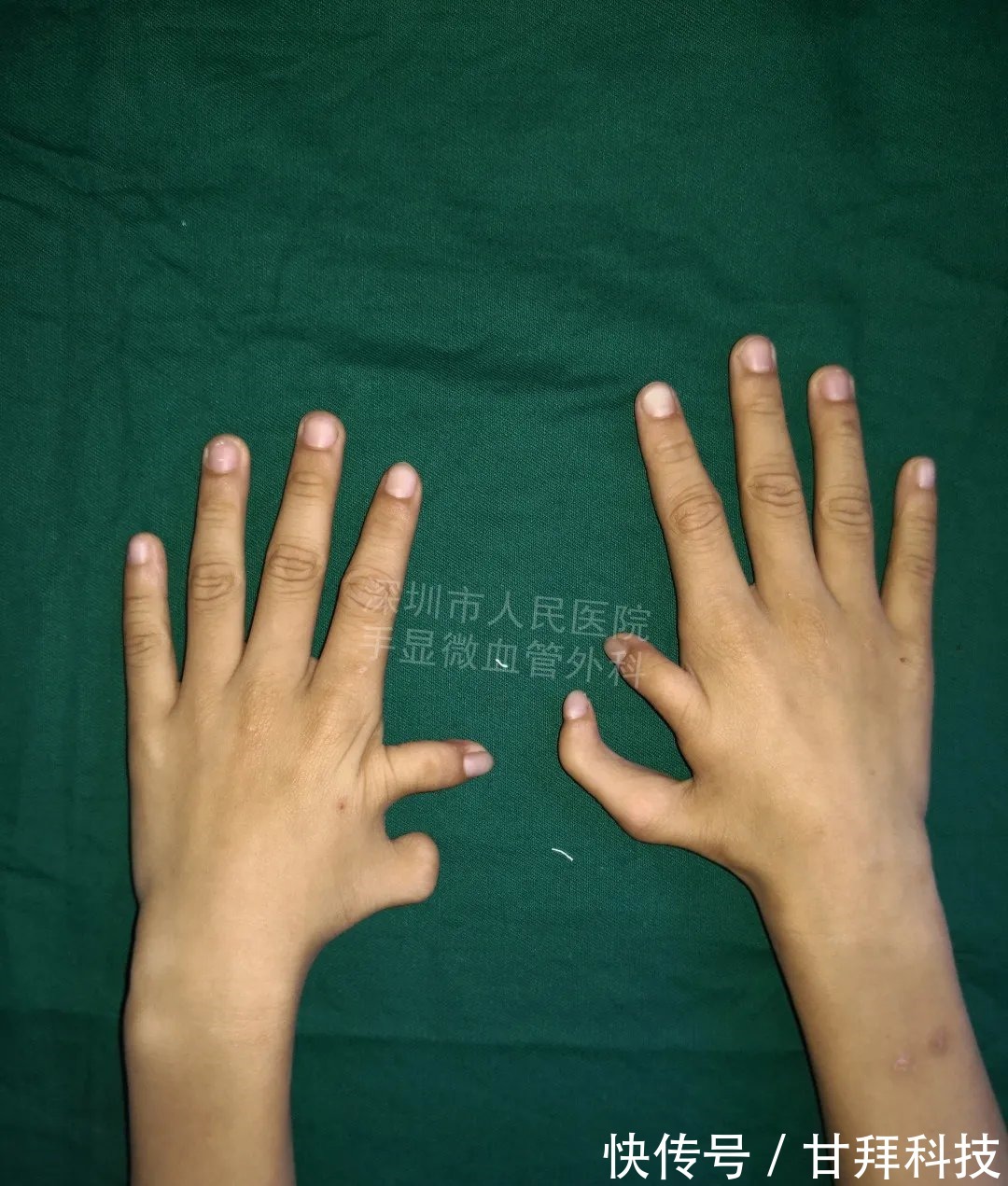 男孩|得了这病,12岁男孩手指比香蕉还粗!7种常见的手部畸形,家长们要注意