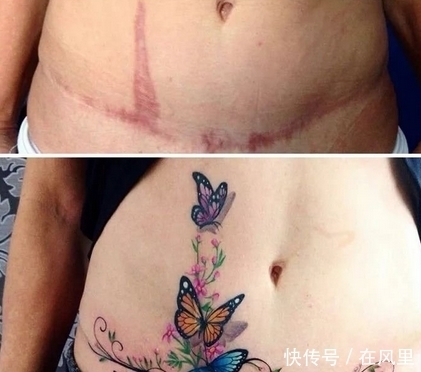 当丑陋的疤痕,遇上纹身师的智慧,原来疤痕也可以变得很美