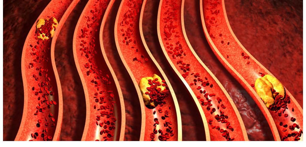 膳食纤维|一种粗粮吃一口等于吃10斤猪油，不及时撤下桌，小心脑梗找上你