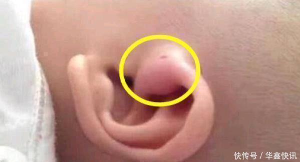 儿子|儿子的耳朵上有个小洞宝妈试图挤压,导致孩子昏迷,被送到医院