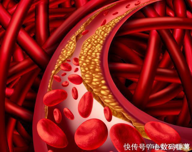  高血脂|血脂高的人，4件事坚持1个月，甘油三酯降到1.6，清理血管垃圾
