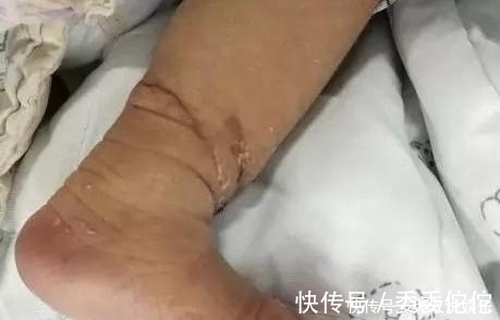 农药残留|胎儿在妈妈肚中被绑腿,出生后被告知要截肢,宝妈瘫地痛哭