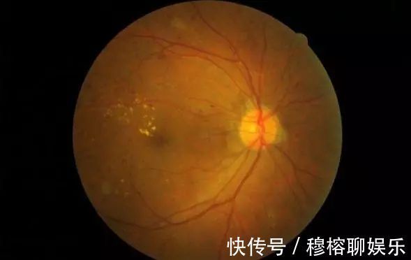 高血压|51岁男子，昏迷入院，2小时后离世，血压高，饭后少做3件事