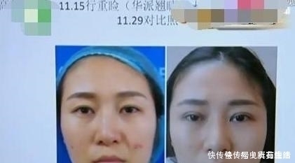 女孩|90后女孩割完双眼皮,男朋友和她提分手:你像是30岁