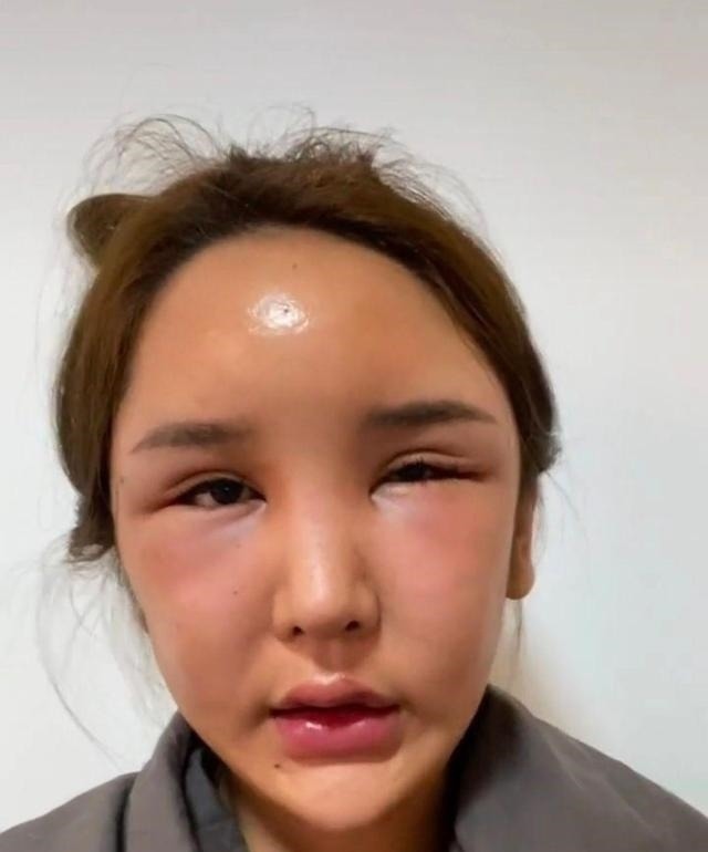 整形手术 8年的整形手术花费了100多万，光额头就打了200多支玻尿酸