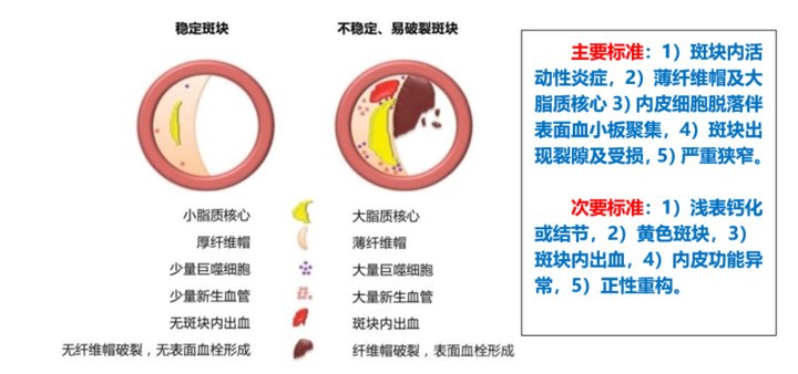 斑块|新技术！淄博市中心医院头颈部高分辨MR血管壁成像：让斑块立显