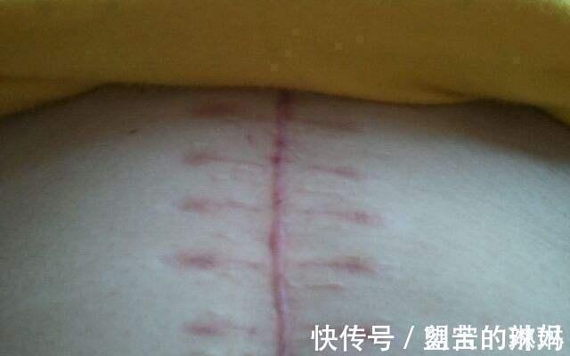 产妇|剖宫产“横竖”怎么选择?哪个更有利于产后恢复?医生教你这么选