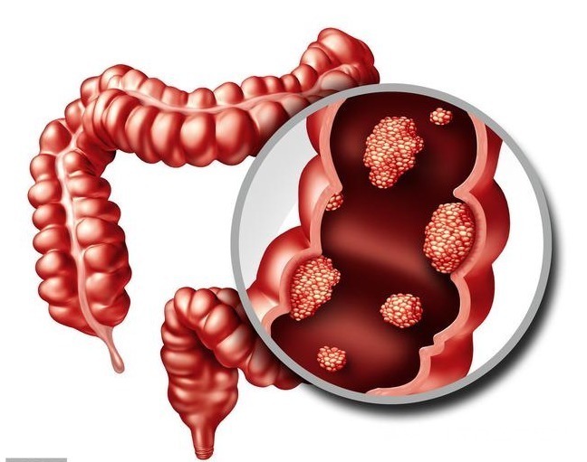 检查|身体“染上”肠癌，排便会有3个明显异样，这三类人最好定期检查