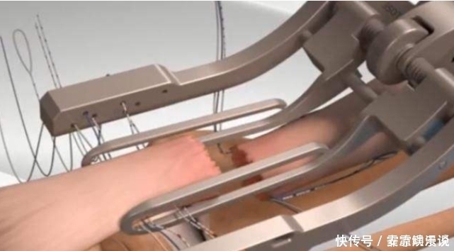 过程|病人断掉的“筋”是怎么接起来的看完动画演示过程,总算明白了