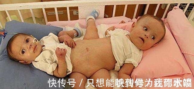 连体|若连体婴儿其中一个不幸离世,另一个会怎样呢?
