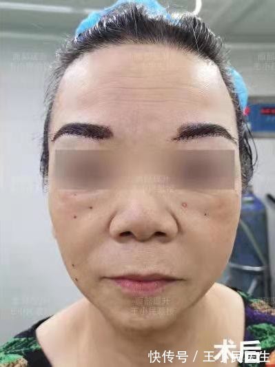 皮肤 拉皮除皱王小民教授:年纪大了还能做小拉皮吗,让她来告诉你!