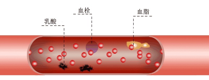 脑梗死|为什么脑梗死容易复发，有什么办法可以预防？医生为您讲清楚