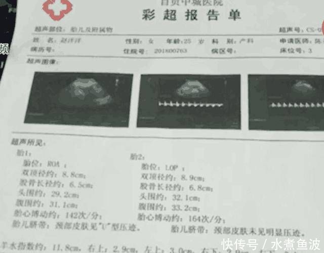 双胞胎|孕检怀了双胞胎,医生却只接生了一个,还有一个去哪了