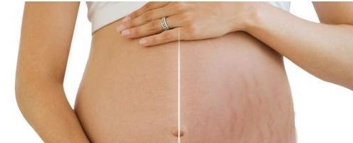 美国运动医学协会|怀孕后如何预防妊娠纹？孕期做好这3件小事情，赶走“花纹肚”