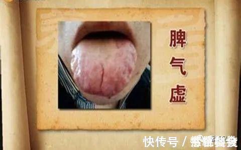 肾囊肿|人虚生百病,气虚、肺虚、脾虚,4味中药补虚不上火,身体更健康