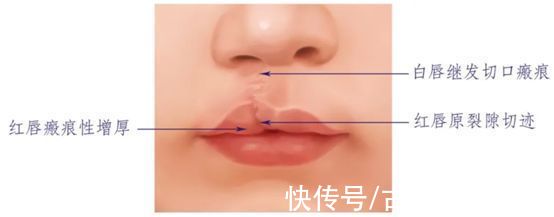 疤痕 唇裂术后会不会留疤？家长的在意点尤其重要