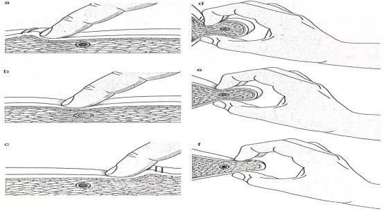 扳机点|你不能忽视的肌肉扳机点，85%的疼痛和它有关