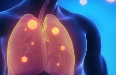 结节|如何让你的肺结节变小甚至消失?听听医生怎么说